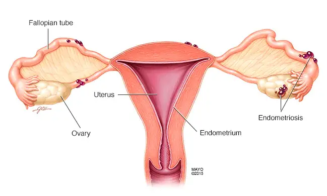 Endometriosis